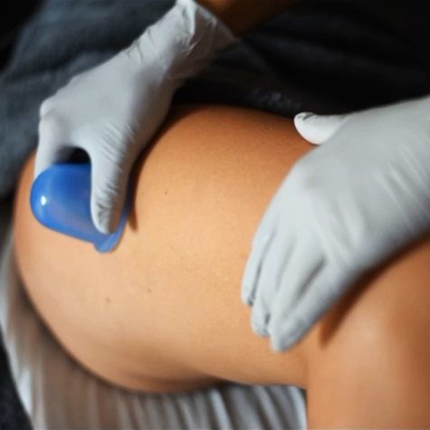 Terapia com ventosas