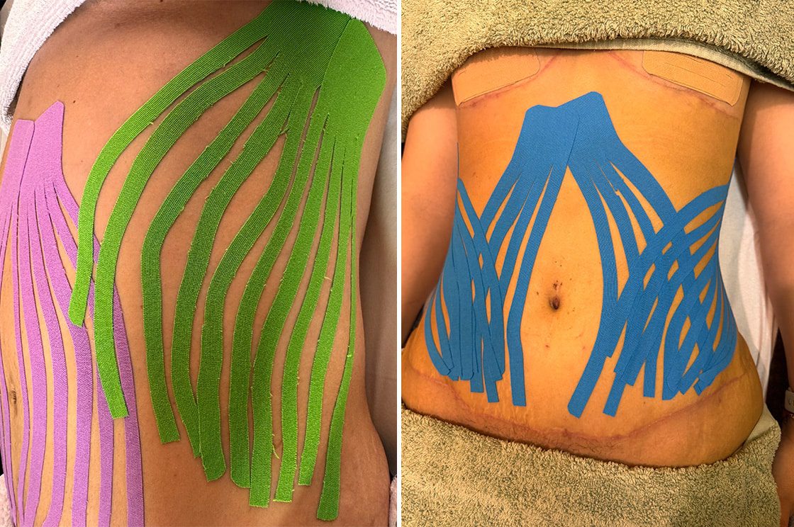 Cuidados pós-operatórios e bandagem Kinesio (KT-Taping)