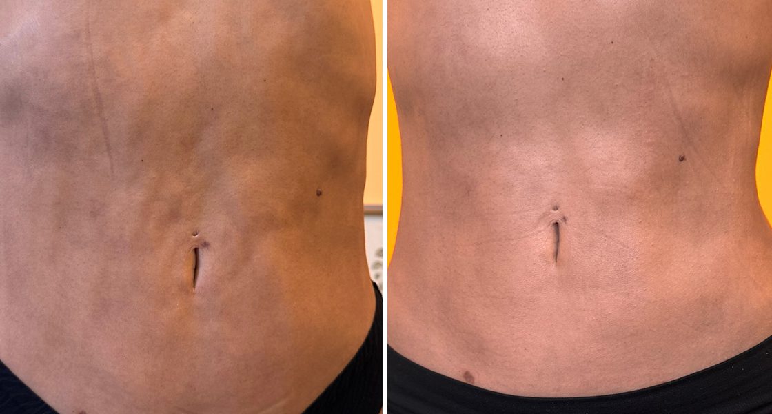 Resultados da fibrose