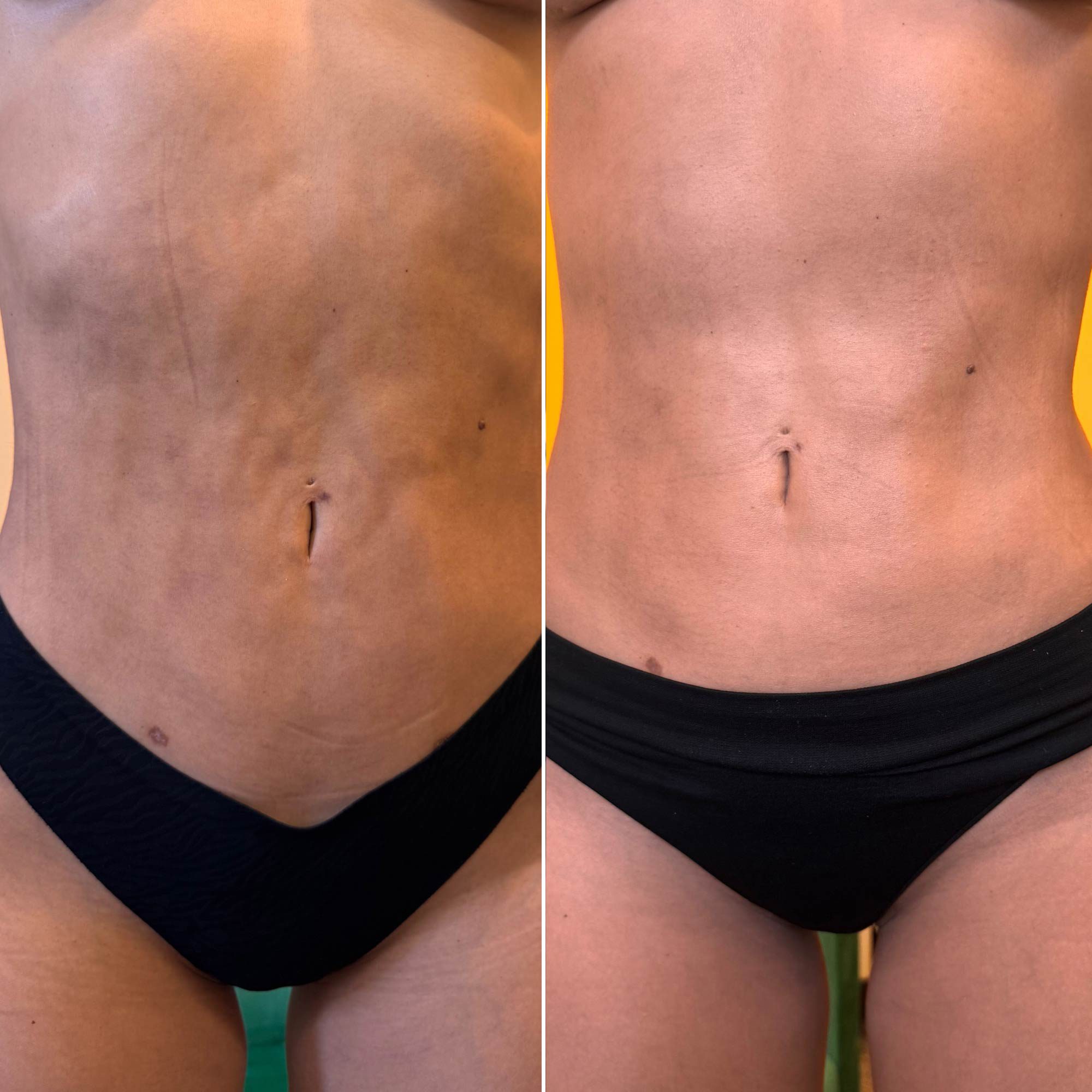 Resultados da fibrose